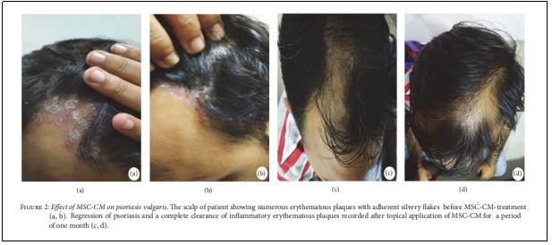图2：MSC-CM对寻常型银屑病的影响。