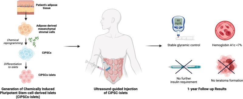 图示： 通过将患者脂肪组织提取的间充质干细胞化学重编程为诱导多能干细胞并分化为胰岛，再注射入腹直肌前鞘。