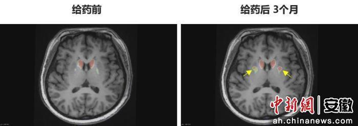 图为李女士 PET-DAT/MRI融合图像术前与术后三个月对比。 图为李女士 PET-DAT/MRI融合图像术前与术后三个月对比。