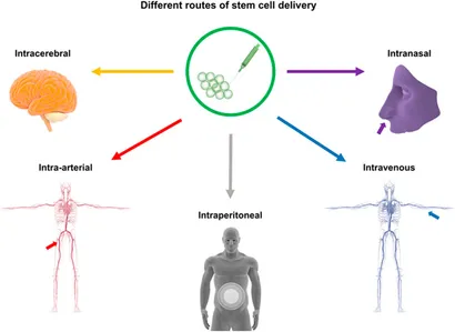 干细胞移植途径：该图展示了用于中风治疗的干细胞输送途径，包括脑内（立体定向注射）、血管内（静脉/动脉）、腹腔内、脑室内、静脉内、鼻内和鞘内注射方法。