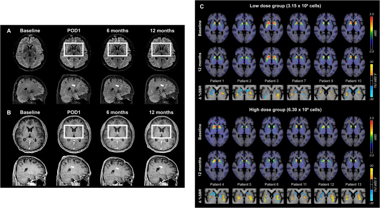 图6:代表性脑部MRI图像以及A9-DPC移植后18F -FP-CIT摄取量的个体水平变化 图6:代表性脑部MRI图像以及A9-DPC移植后18F -FP-CIT摄取量的个体水平变化