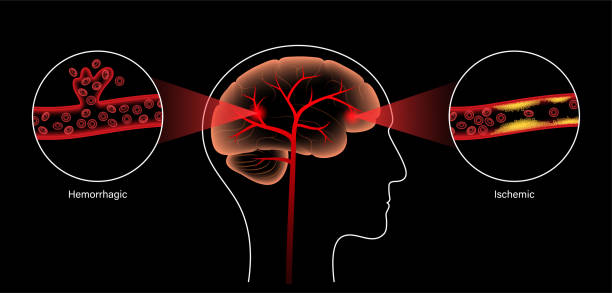 脐带干细胞静脉注射治疗脑卒中?Ⅰ期人体研究结果公布:临床显示安全有效 脐带干细胞静脉注射治疗脑卒中?Ⅰ期人体研究结果公布:临床显示安全有效