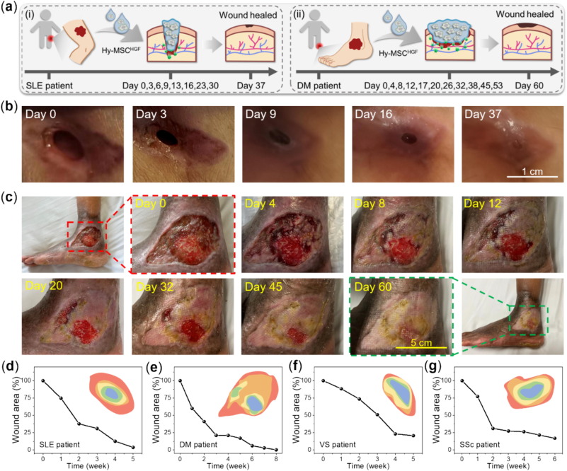 图：MSC-HGF负载水凝胶在临床上治愈人类RW伤口。