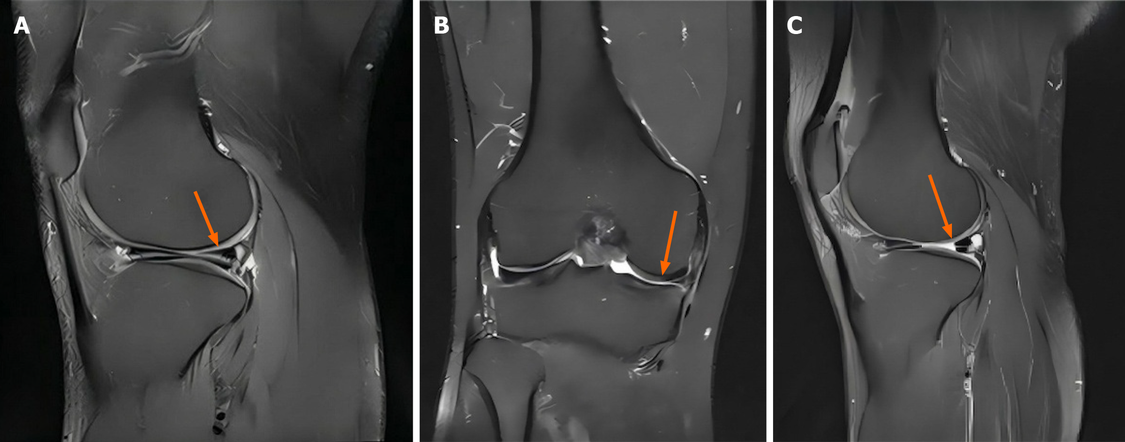 图2：间充质干细胞治疗后半月板组织的代表性磁共振成像图像。