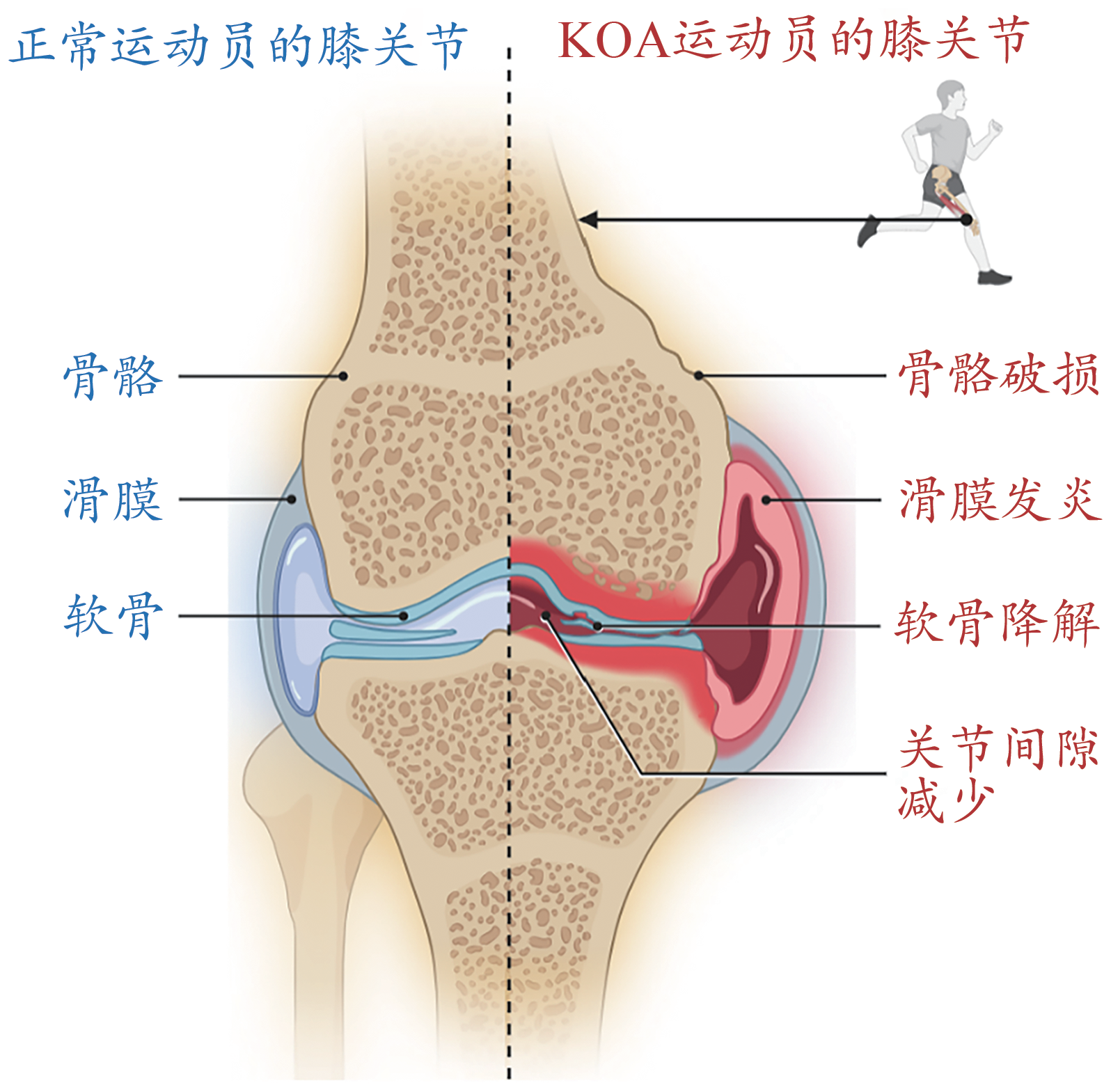 图1:正常运动员与KOA运动员的膝关节 图1:正常运动员与KOA运动员的膝关节