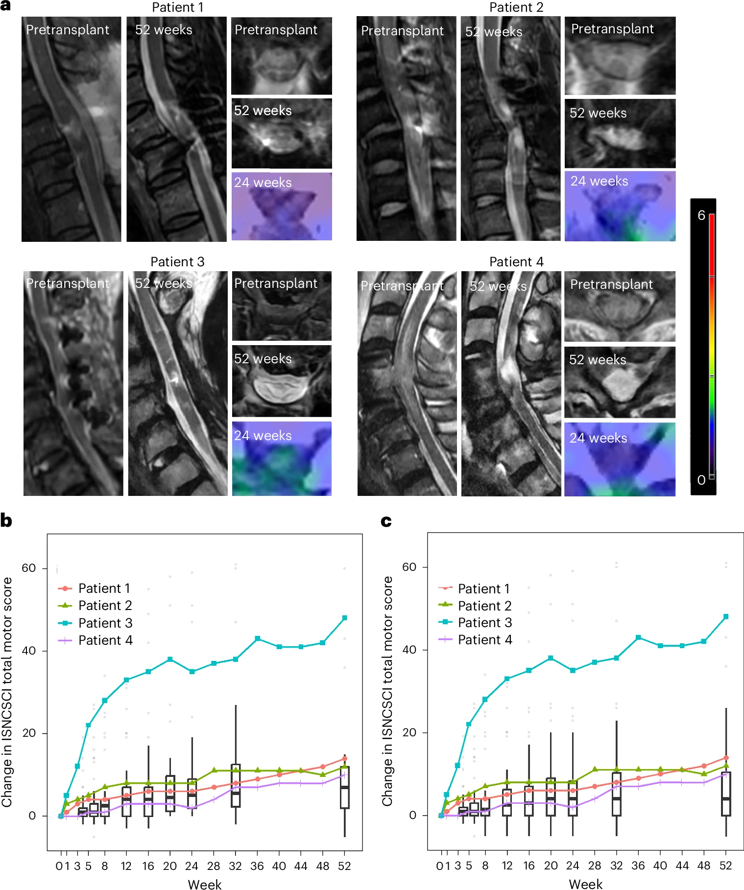 图3:iPSC-NS/PC移植后的影像学和运动评分变化。 图3:iPSC-NS/PC移植后的影像学和运动评分变化。